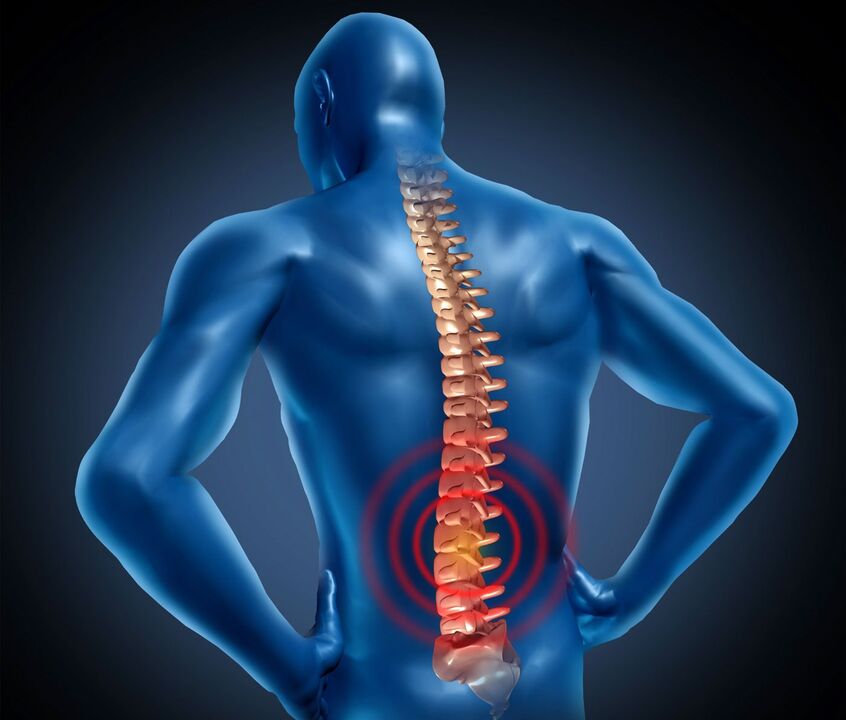 Lumbale Osteochondrose
