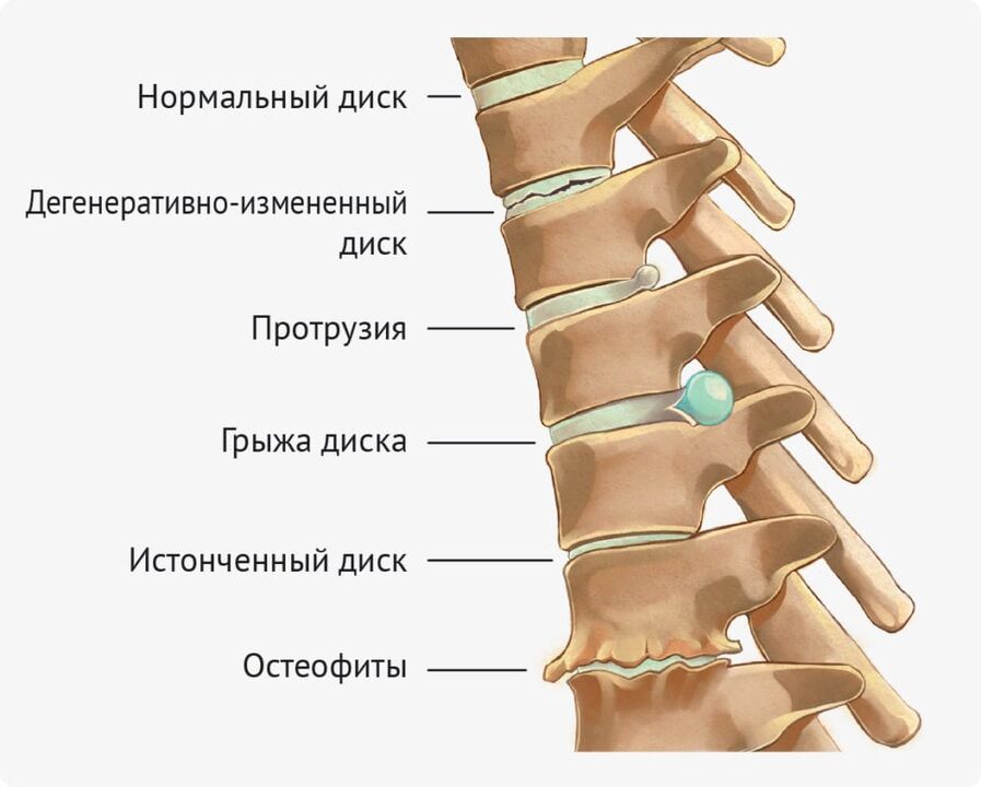 Scheibendeformitäten für die lumbale Osteochondrose