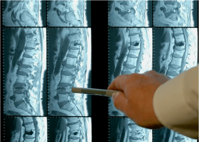 Osteochondrose -Sorten in der Wirbelsäule