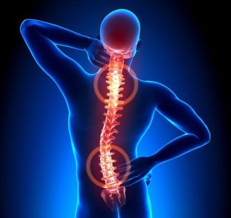 Osteochondrose der Wirbelsäule