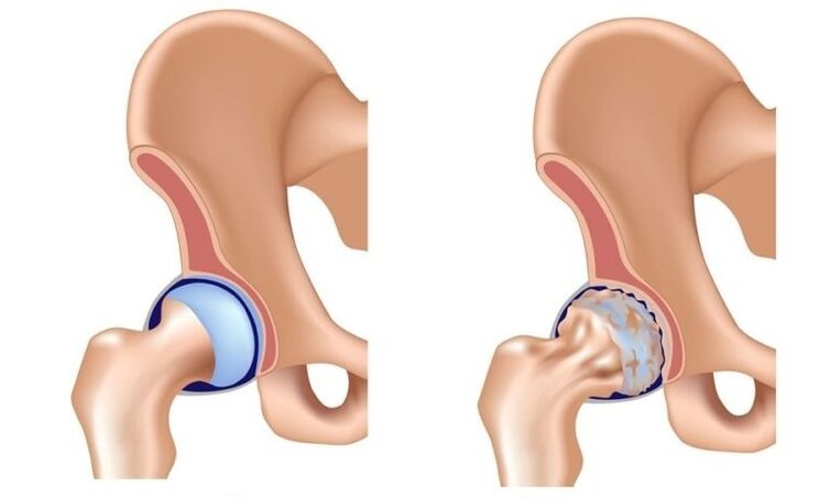 Gesundes Gelenk und Gelenk mit Arthrose