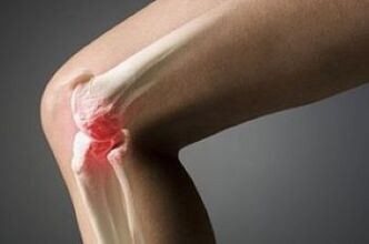 Arthrose des Kniegelenks ist eine Läsion des Knorpelgewebes