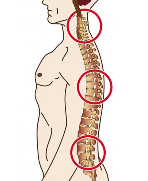 Wirbelsäulenabteilungen, in denen Osteochondrose auftritt