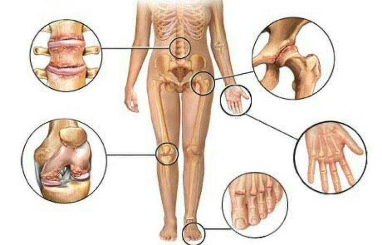 Art und Grad der Arthrose