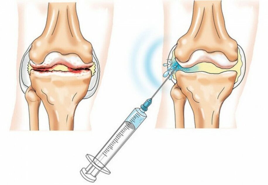 Injektion in das Kniegelenk bei Arthrose