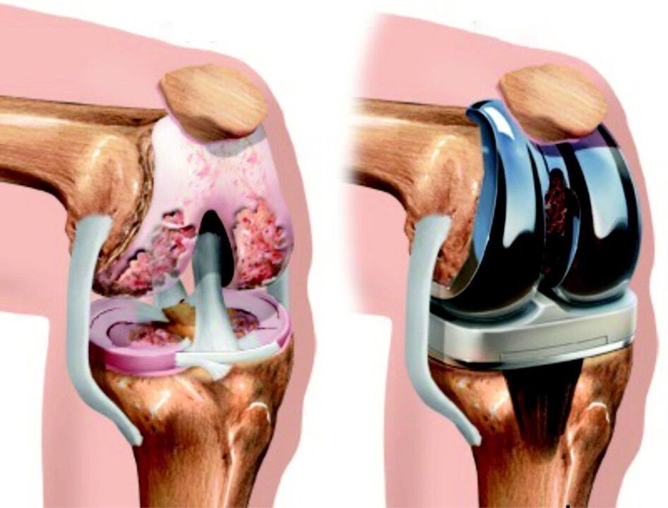 Bei einer Totalschädigung des Kniegelenks durch Arthrose kann diese durch Endoprothetik wiederhergestellt werden