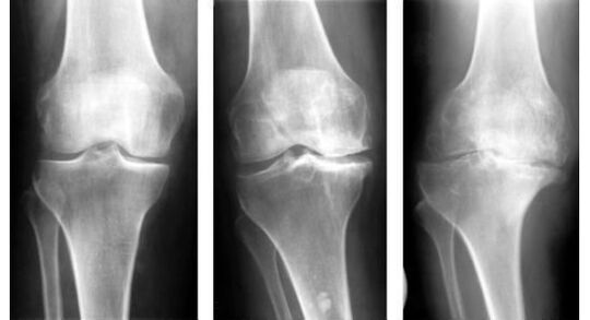 Eine obligatorische diagnostische Maßnahme zur Feststellung einer Kniearthrose ist eine Röntgenaufnahme